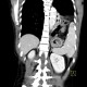 Rupture of the diaphragm, diaphragmatic hernia: CT - Computed tomography